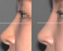 Revision rhinoplasty – Silicone showing nose