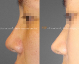 Septal cartilage rhinoplasty