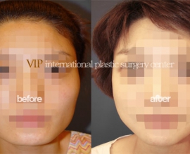 Asymmetric jaw line correction