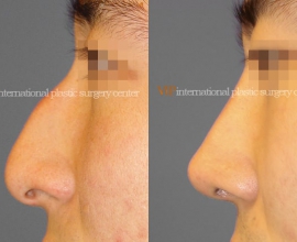 Nose bridge correction