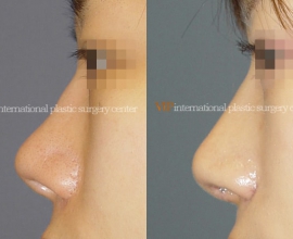 Nostril correction