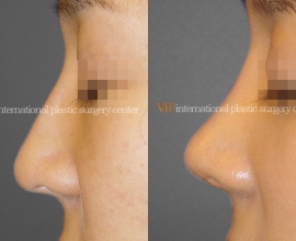 Septal cartilage rhinoplasty