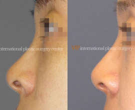 Nostril correction