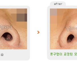 Revision rhinoplasty – Asymmetric nostrils