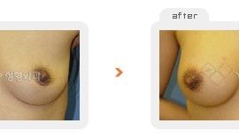 Breast augmentation