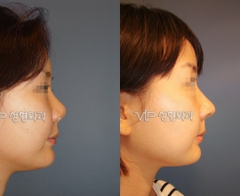 Contraction due to silicone – Revision with Rib cartilage rhinoplasty