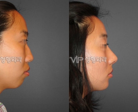 VIP Harmony rhinoplasty