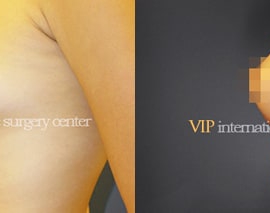 Breast surgery