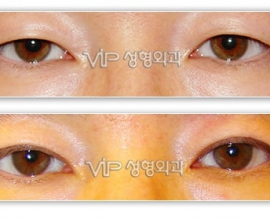 Upper blepharoplasty