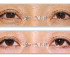 Lower blepharoplasty