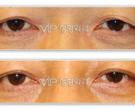 Upper blepharoplasty