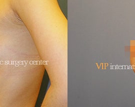 Breast surgery