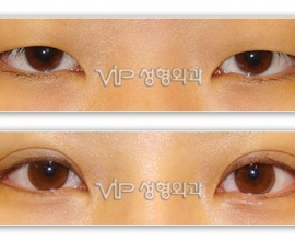 Upper & Lower blepharoplasty