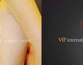 Breast surgery