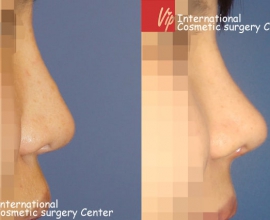 Deviated nose correction