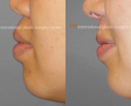 Protruded mouth correction