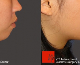 Genioplasty – bringing chin bone forward