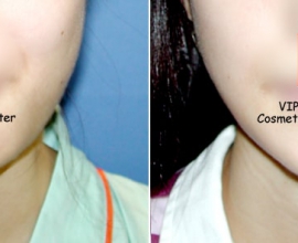 V-line jaw reduction ( T-Square surgery )