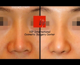 Revision of silicone showing nose – Rib cartilage rhinoplasty