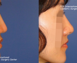 VIP High technique rhinoplasty