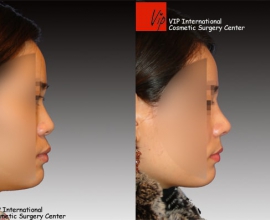 VIP Harmony rhinoplasty (correction of mid face retrusion & protruded …