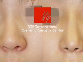 Autologous rhinoplasty