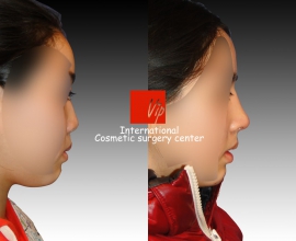 Short & Flat nose – Rib cartilage rhinoplasty