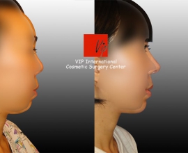 Harmony rhinoplasty – Septal deviation correction+balanced profile vie…