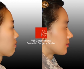 Harmony rhinoplasty