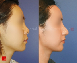 Harmony rhinoplasty