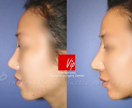 Autologous rhinoplasty