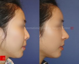 Silicone revision case- Rib cartilage rhinoplasty