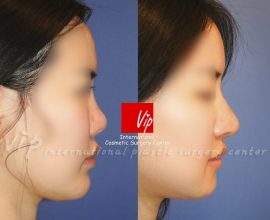 Ribcartilage rhinoplasty – Improvement of mouth protrusion