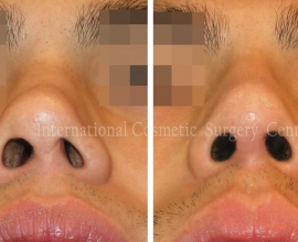 Nasal septal deviation Revision case