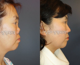 Revision rhinoplasty with Rib cartilage – Severe collapsion and contru…