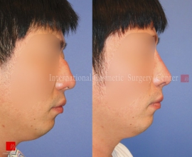 2nd Op. – Rib cartilage rhinoplasty