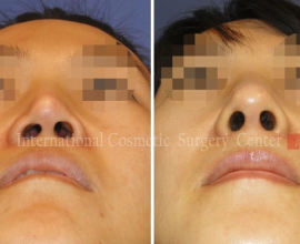 Revision rhinoplasty using Rib cartilage