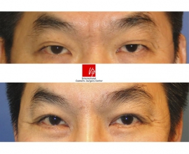 Forehead endoscope surgery & Upper blepharoplasty