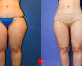 Body Liposuction