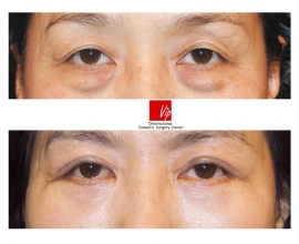 Lower eyelid blepharoplasty