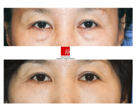 Lower eyelid blepharoplasty (eye bag removal)