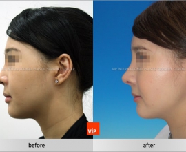 Harmony face rhinoplasty considering balance between forehead, nose an…