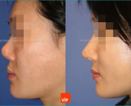 Harmony Rhinoplasty