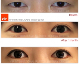 Ptosis correction