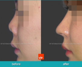 Post infection contracted nose correction with rib cartilage rhinoplas…