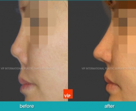 Post infection contracted nose correction with rib cartilage rhinoplas…