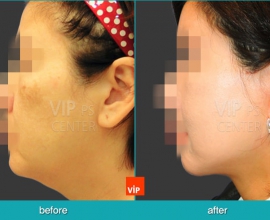 High SMAS Face / Neck Lift with Dermis graft