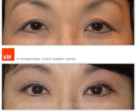 Brow lift