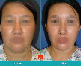 High SMAS Face / Necklift, Lipolysis