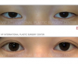 Ptosis correction